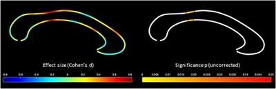 Preliminary evidence of links between ayahuasca use and the corpus callosum